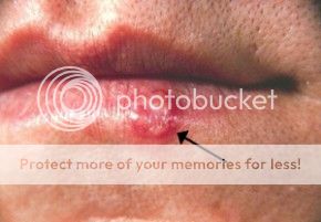 oral herpes pictures on tongue